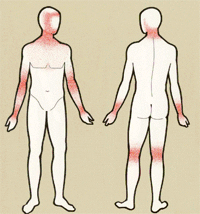 Clarification de la dermatite atopique