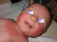 Neurodermitis beim Säuglingen