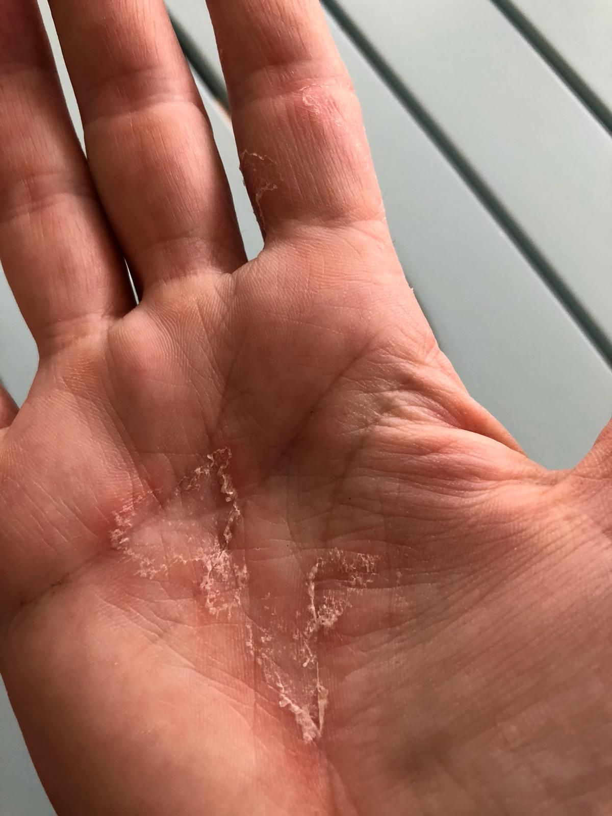 Psoriasis à la main
