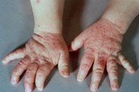 Main avec dermatite atopique