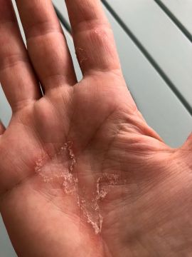 Psoriasis à la main