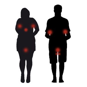 Parti del corpo interessate con acne Inversa (idrosadenite suppurativa)
